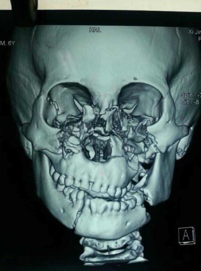小文的脸部骨头裂成100多块 西京医院提供