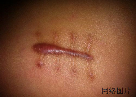 22岁<em>女孩</em>因打针致<em>青蛙腿</em>无法并膝下蹲 --陕西